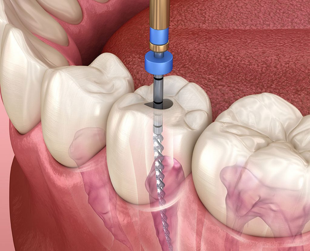 Root canal treatment procedure in London